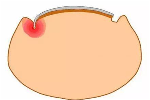 甲溝炎指甲長出來就好了嗎 甲溝炎指甲長肉里好深怎么辦 甲溝炎指甲長出來就好了嗎 甲溝炎指甲長肉里好深怎么辦