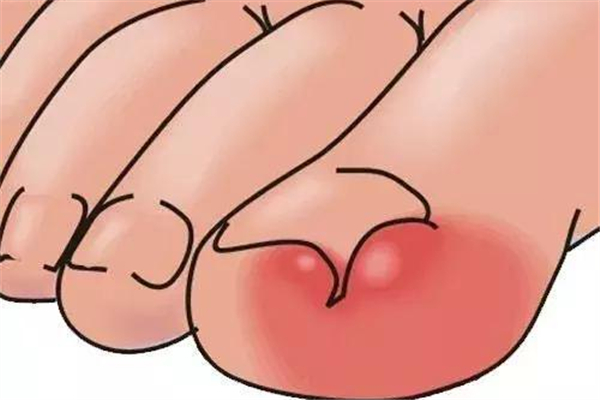 甲溝炎會長手上嗎 手上的甲溝炎怎么處理 甲溝炎會長手上嗎 手上的甲溝炎怎么處理