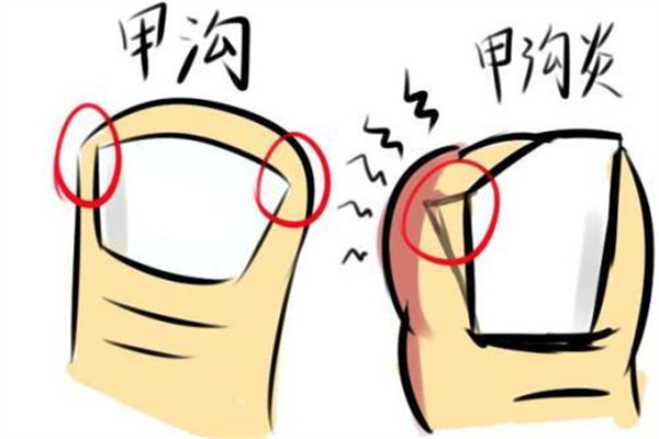 甲溝炎要拔掉整個(gè)指甲嗎 甲溝炎指甲拔了還能在長出來嗎 甲溝炎要拔掉整個(gè)指甲嗎 甲溝炎指甲拔了還能在長出來嗎