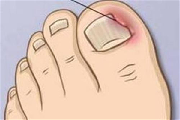 甲溝炎會變成灰指甲嗎 甲溝炎會導致什么后果 甲溝炎會變成灰指甲嗎 甲溝炎會導致什么后果