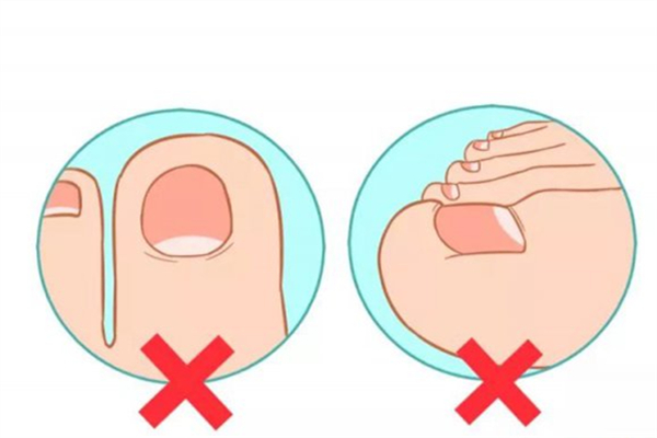 甲溝炎會復(fù)發(fā)嗎 甲溝炎為什么老是反反復(fù)復(fù) 甲溝炎會復(fù)發(fā)嗎 甲溝炎為什么老是反反復(fù)復(fù)