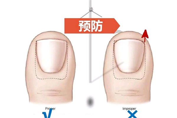 甲溝炎會變成灰指甲嗎 甲溝炎會導致什么后果 甲溝炎會變成灰指甲嗎 甲溝炎會導致什么后果