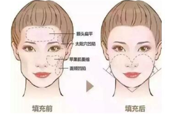 自體填充幾天可以消腫 自體填充后有哪些注意的地方 自體填充幾天可以消腫 自體填充后有哪些注意的地方