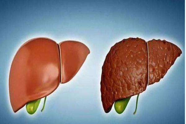 乙肝是肝炎的一種嗎 乙肝是如何被傳染上的 乙肝是肝炎的一種嗎 乙肝是如何被傳染上的