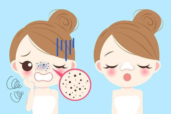 黑頭要定期清理嗎 黑頭多久清理一次比較好 黑頭要定期清理嗎 黑頭多久清理一次比較好