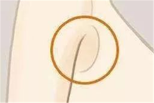 副乳有硬塊怎么辦 副乳有硬塊不疼怎么回事 副乳有硬塊怎么辦 副乳有硬塊不疼怎么回事