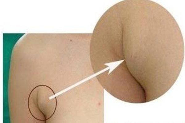 副乳穿內(nèi)衣可以矯正嗎 副乳穿衣服磨怎么辦 副乳穿內(nèi)衣可以矯正嗎 副乳穿衣服磨怎么辦