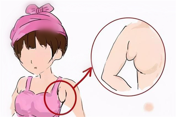 副乳切除好還是不切 副乳切除會留疤嗎 副乳切除好還是不切 副乳切除會留疤嗎