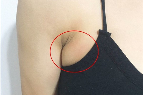 副乳切除對(duì)身體有傷害嗎 副乳切除有什么危害 副乳切除對(duì)身體有傷害嗎 副乳切除有什么危害