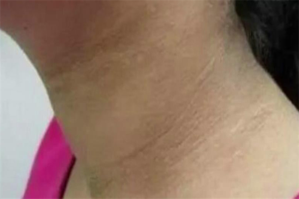 脖子黑黑的洗不掉是什么原因 脖子黑黑的怎么洗干凈 脖子黑黑的洗不掉是什么原因 脖子黑黑的怎么洗干凈