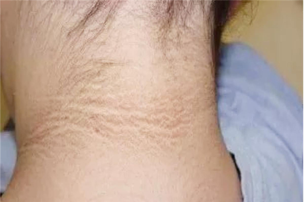 脖子黑黑的洗不掉是什么原因 脖子黑黑的怎么洗干凈 脖子黑黑的洗不掉是什么原因 脖子黑黑的怎么洗干凈