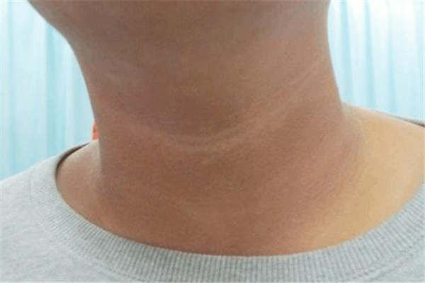 脖子黑黑的洗不掉是什么原因 脖子黑黑的怎么洗干凈 脖子黑黑的洗不掉是什么原因 脖子黑黑的怎么洗干凈