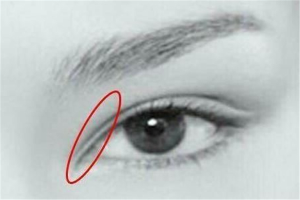 雙眼皮手術會失敗嗎 雙眼皮手術失敗了還能有效恢復嗎 雙眼皮手術會失敗嗎 雙眼皮手術失敗了還能有效恢復嗎