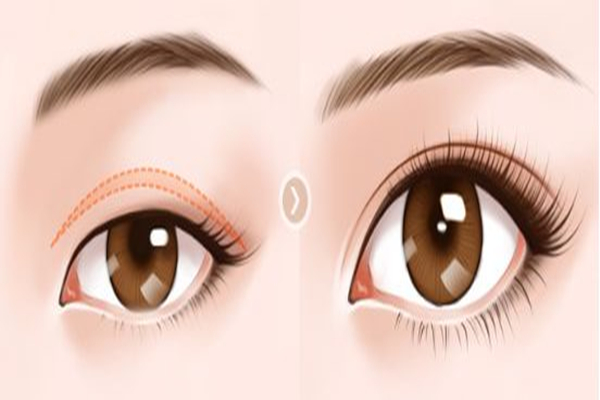 雙眼皮手術(shù)會留疤嗎 雙眼皮手術(shù)有疤痕怎么辦 雙眼皮手術(shù)會留疤嗎 雙眼皮手術(shù)有疤痕怎么辦