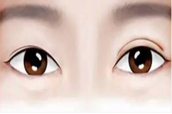 雙眼皮手術會失敗嗎 雙眼皮手術失敗了還能有效恢復嗎 雙眼皮手術會失敗嗎 雙眼皮手術失敗了還能有效恢復嗎