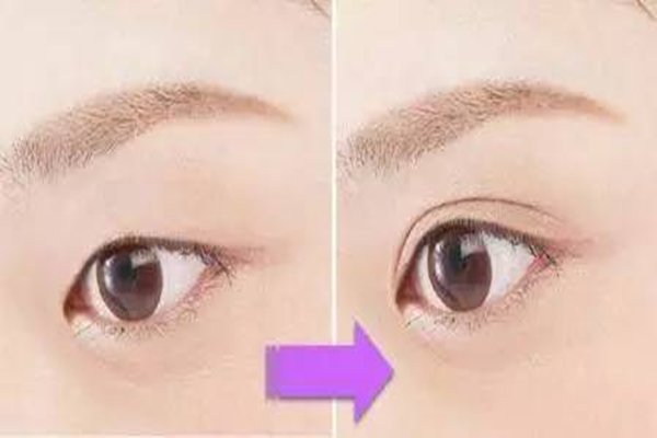 雙眼皮手術(shù)多久能恢復(fù)自然 雙眼皮手術(shù)多少錢(qián)一次 雙眼皮手術(shù)多久能恢復(fù)自然 雙眼皮手術(shù)多少錢(qián)一次