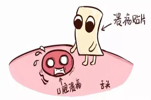 口腔潰瘍會引起口臭嗎 口腔潰瘍會引起口腔癌嗎 口腔潰瘍會引起口臭嗎 口腔潰瘍會引起口腔癌嗎