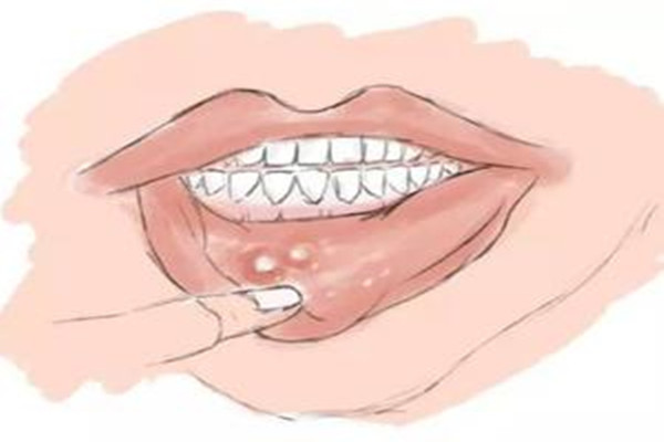 口腔潰瘍會導致臉腫嗎 口腔潰瘍會導致喉嚨痛嗎 口腔潰瘍會導致臉腫嗎 口腔潰瘍會導致喉嚨痛嗎