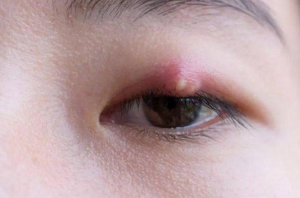 寶寶眼睛長了麥粒腫怎么辦 寶寶長麥粒腫的原因 寶寶眼睛長了麥粒腫怎么辦 寶寶長麥粒腫的原因