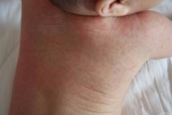 寶寶長痱子有點化膿了怎么辦 寶寶長痱子會癢嗎 寶寶長痱子有點化膿了怎么辦 寶寶長痱子會癢嗎