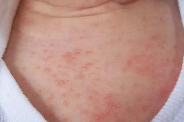 寶寶長(zhǎng)痱子用什么擦效果好 寶寶長(zhǎng)痱子怎么快速消除止癢 寶寶長(zhǎng)痱子用什么擦效果好 寶寶長(zhǎng)痱子怎么快速消除止癢