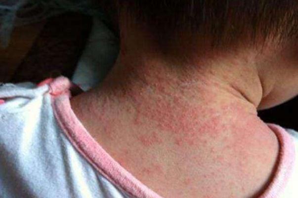 寶寶長痱子可以吃蝦嗎 寶寶長痱子可以打疫苗嗎 寶寶長痱子可以吃蝦嗎 寶寶長痱子可以打疫苗嗎