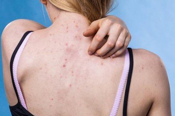 濕氣重是不是愛出汗 濕氣重是不是要少喝水 濕氣重是不是愛出汗 濕氣重是不是要少喝水