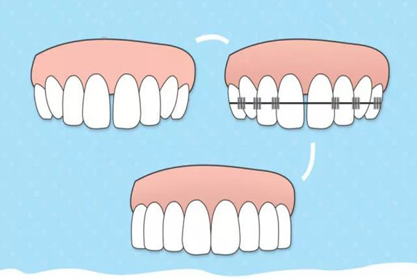 牙齒矯正會(huì)反彈嗎 牙齒矯正會(huì)改變嘴唇嗎 牙齒矯正會(huì)反彈嗎 牙齒矯正會(huì)改變嘴唇嗎