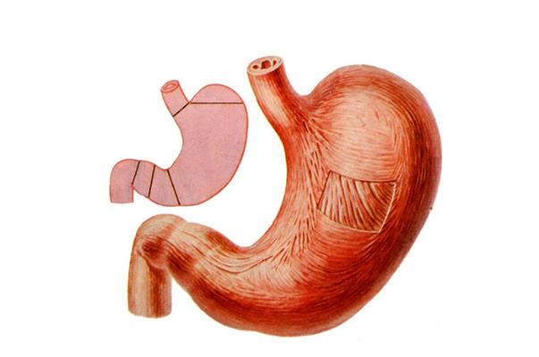 胃出血吃什么藥最好 胃出血是怎么引起的 胃出血吃什么藥最好 胃出血是怎么引起的