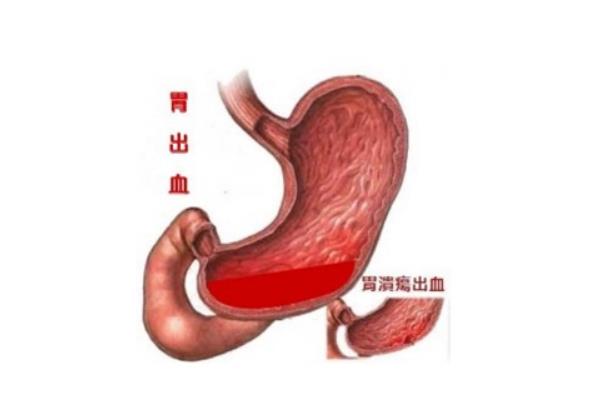 胃出血有什么癥狀表現(xiàn) 胃出血后吃什么補(bǔ)血又養(yǎng)胃 胃出血有什么癥狀表現(xiàn) 胃出血后吃什么補(bǔ)血又養(yǎng)胃