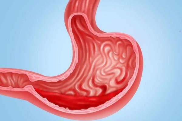 胃出血有什么癥狀表現(xiàn) 胃出血后吃什么補(bǔ)血又養(yǎng)胃 胃出血有什么癥狀表現(xiàn) 胃出血后吃什么補(bǔ)血又養(yǎng)胃