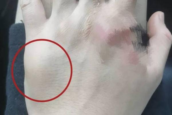 程序員手疼7年查出骨腫瘤 骨腫瘤是怎么引起的 程序員手疼7年查出骨腫瘤 骨腫瘤是怎么引起的