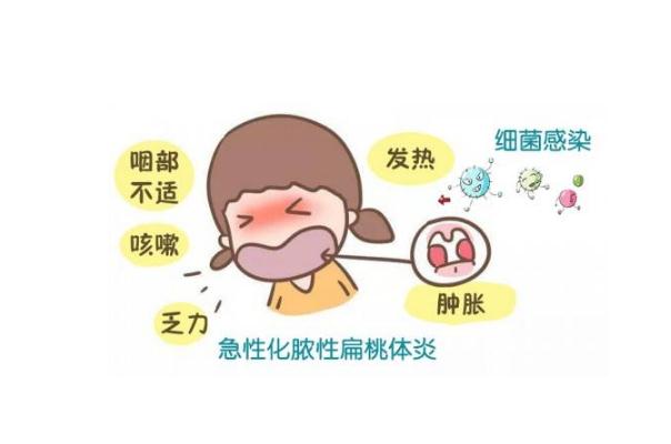 扁桃體發(fā)炎會引起頭痛嗎 扁桃體發(fā)炎會自己自愈嗎 扁桃體發(fā)炎會引起頭痛嗎 扁桃體發(fā)炎會自己自愈嗎