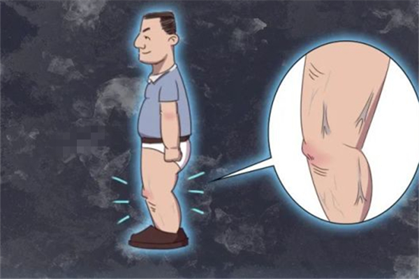 靜脈曲張會(huì)死人嗎 靜脈曲張用什么辦法治療最好 靜脈曲張會(huì)死人嗎 靜脈曲張用什么辦法治療最好