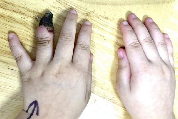 家人錯(cuò)誤包扎致3歲女童手指壞死 傷口如何正確包扎 家人錯(cuò)誤包扎致3歲女童手指壞死 傷口如何正確包扎