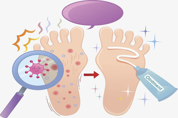 腳氣怎么治療能根除 腳氣是怎么引起的 腳氣怎么治療能根除 腳氣是怎么引起的