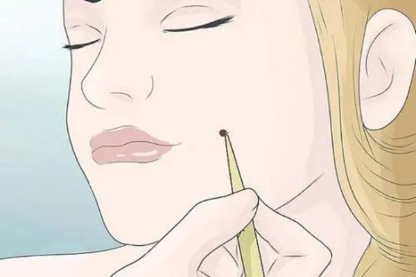 點(diǎn)痣可以化妝嗎 點(diǎn)痣可以敷面膜嗎 點(diǎn)痣可以化妝嗎 點(diǎn)痣可以敷面膜嗎