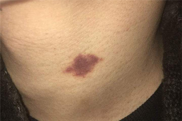 吸草莓出血怎么回事 吸草莓可以吸哪些部位 吸草莓出血怎么回事 吸草莓可以吸哪些部位