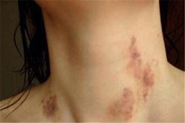 種草莓在脖子上的危害 種草莓在脖子哪個(gè)位置最安全 種草莓在脖子上的危害 種草莓在脖子哪個(gè)位置最安全