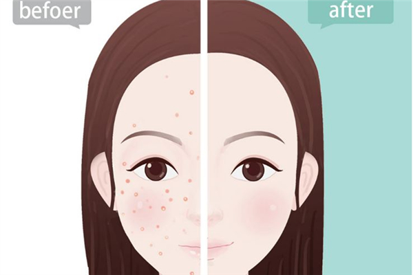 果酸換膚多少錢(qián) 果酸換膚的功效和作用