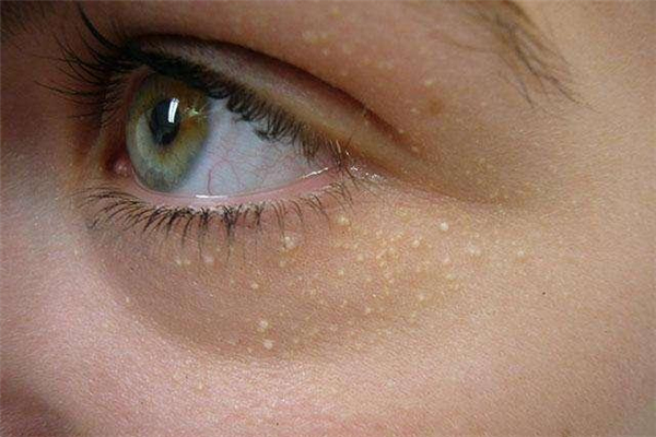 脂肪粒如何去除 脂肪粒形成的主要原因 脂肪粒如何去除 脂肪粒形成的主要原因