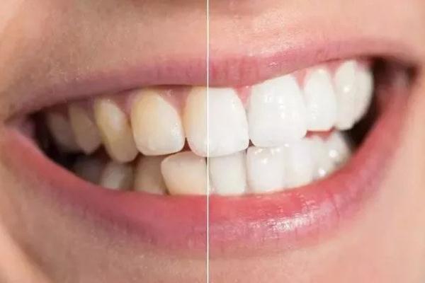 牙黃怎么變白簡單方法 牙黃是什么原因?qū)е碌? alt=