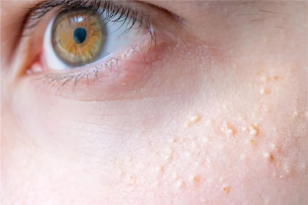 脂肪粒摳掉了留疤了怎么辦 脂肪粒怎么消除在眼部周圍的 脂肪粒摳掉了留疤了怎么辦 脂肪粒怎么消除在眼部周圍的