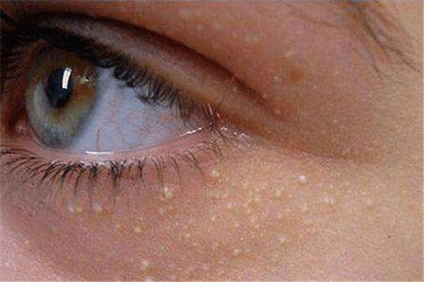 ?脂肪粒去除了還會(huì)長(zhǎng)嗎 脂肪粒怎么預(yù)防 ?脂肪粒去除了還會(huì)長(zhǎng)嗎 脂肪粒怎么預(yù)防