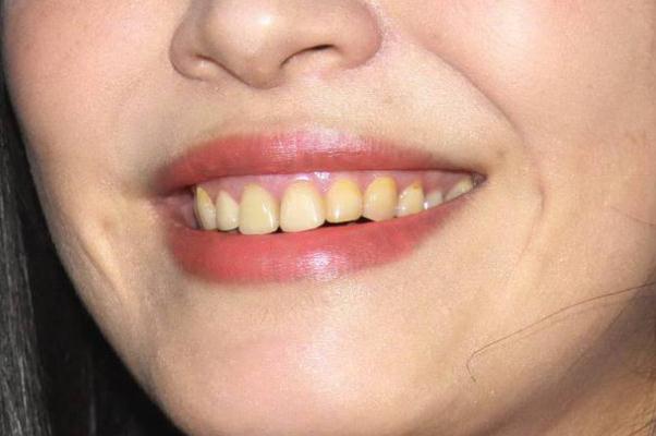 牙黃怎么變白簡單方法 牙黃是什么原因?qū)е碌? alt=