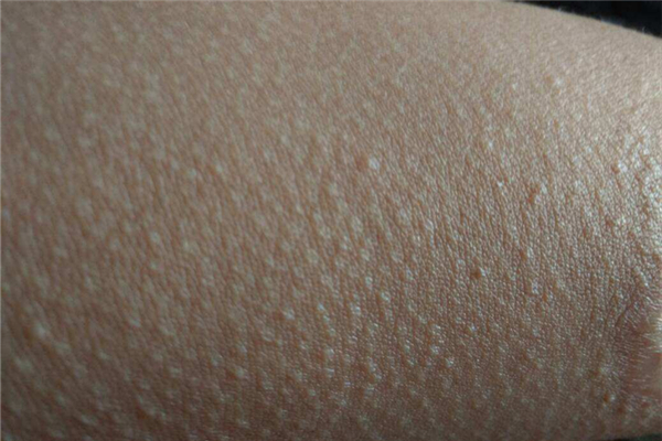 雞皮膚對(duì)健康有影響嗎 雞皮膚有什么危害 雞皮膚對(duì)健康有影響嗎 雞皮膚有什么危害