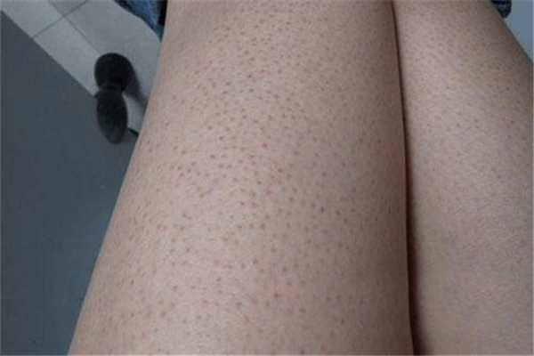 雞皮膚對(duì)健康有影響嗎 雞皮膚有什么危害 雞皮膚對(duì)健康有影響嗎 雞皮膚有什么危害