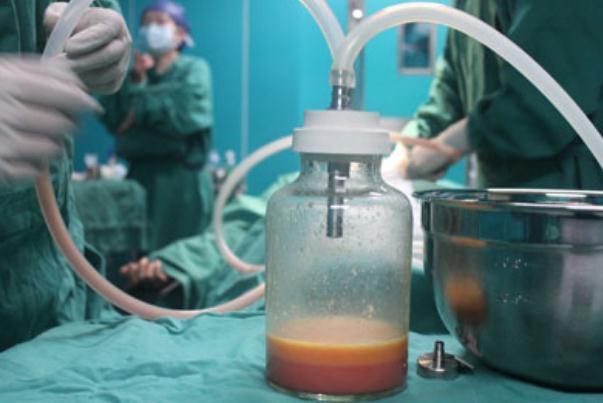 抽脂肪的后遺癥 抽脂肪是怎么抽出來(lái)的 抽脂肪的后遺癥 抽脂肪是怎么抽出來(lái)的