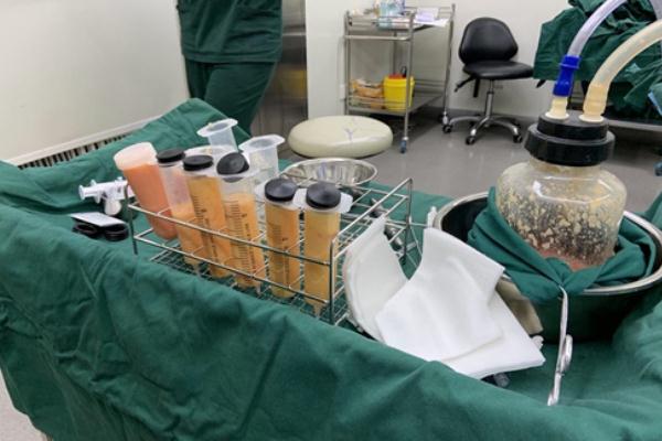 抽脂肪的后遺癥 抽脂肪是怎么抽出來(lái)的 抽脂肪的后遺癥 抽脂肪是怎么抽出來(lái)的