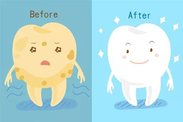 烤瓷牙能否洗牙 烤瓷牙多久要洗一次 烤瓷牙能否洗牙 烤瓷牙多久要洗一次